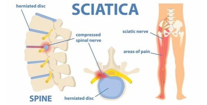 What is Sciatica? - Twin Cities Pain Clinic